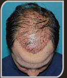 Foto do 1º dia depois do Implante de cabelo