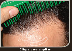 Foto de um resultado com close da linha anterior - Transplante Folicular Total