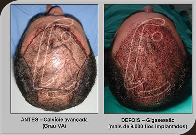 Fotos - Gigasessão - Implante Capilar