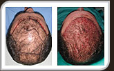 Fotos Gigasessão - Transplante Capilar