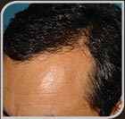 Foto linha anterior natural - Resultado