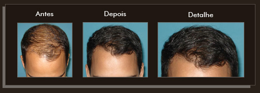Clique para Ampliar e veja os resultados da cirurgia de implante de cabelo