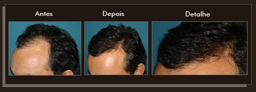 Clique para Ampliar e veja os resultados da cirurgia de implante de cabelo