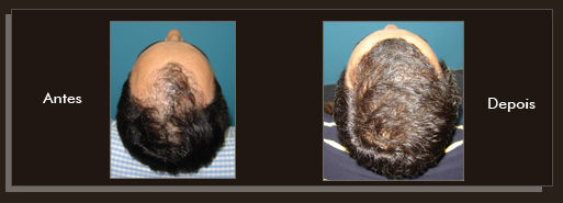 Clique para Ampliar e veja os resultados da cirurgia de implante de cabelo