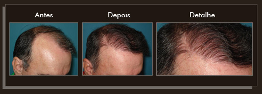Clique para Ampliar e veja os resultados da cirurgia de implante de cabelo