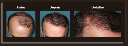 Clique para Ampliar e veja os resultados da cirurgia de implante de cabelo