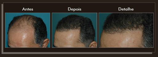 Clique para Ampliar e veja os resultados da cirurgia de implante de cabelo