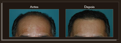 Clique para Ampliar e veja os resultados da cirurgia de implante de cabelo