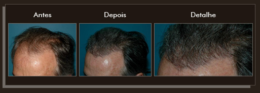 Clique para Ampliar e veja os resultados da cirurgia de implante de cabelo