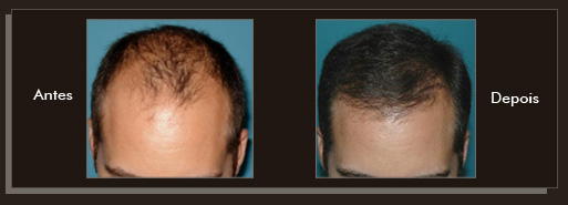 Resultados da cirurgia de implante de cabelo Clique para Ampliar e veja os resultados da cirurgia de implante de cabelo