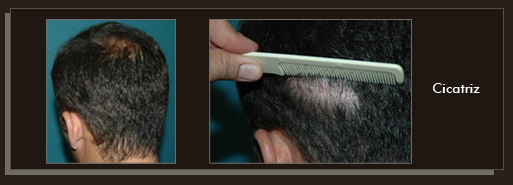 Resultados da cirurgia de implante de cabelo Clique para Ampliar e veja os resultados da cirurgia de implante de cabelo