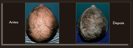 Resultados da cirurgia de implante de cabelo Clique para Ampliar e veja os resultados da cirurgia de implante de cabelo