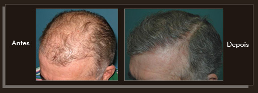 Resultados da cirurgia de implante de cabelo Clique para Ampliar e veja os resultados da cirurgia de implante de cabelo