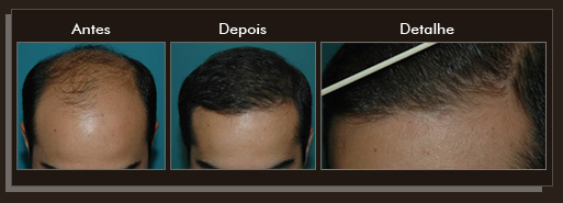 Resultados da cirurgia de implante de cabelo Clique para Ampliar e veja os resultados da cirurgia de implante de cabelo