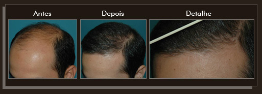 Resultados da cirurgia de implante de cabelo Clique para Ampliar e veja os resultados da cirurgia de implante de cabelo