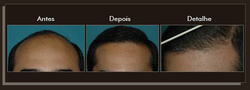 Clique para Ampliar e veja os resultados da cirurgia de implante de cabelo