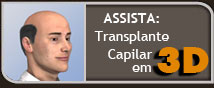 Assista: O Transplante Capilar em 3D