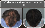 Clique para Ampliar e veja os resultados da cirurgia de implante de cabelo