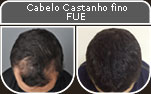 Clique para Ampliar e veja os resultados da cirurgia de implante de cabelo