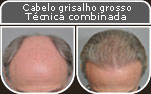 Clique para Ampliar e veja os resultados da cirurgia de implante de cabelo