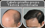 Clique para Ampliar e veja os resultados da cirurgia de implante de cabelo