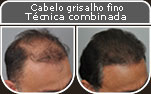 Clique para Ampliar e veja os resultados da cirurgia de implante de cabelo