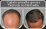 Clique para Ampliar e veja os resultados da cirurgia de implante de cabelo