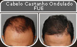 Clique para Ampliar e veja os resultados da cirurgia de implante de cabelo
