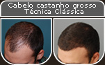 Clique para Ampliar e veja os resultados da cirurgia de implante de cabelo