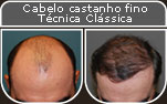 Clique para Ampliar e veja os resultados da cirurgia de implante de cabelo