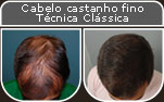 Clique para Ampliar e veja os resultados da cirurgia de implante de cabelo