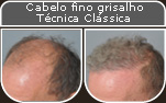Clique para Ampliar e veja os resultados da cirurgia de implante de cabelo