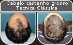 Clique para Ampliar e veja os resultados da cirurgia de implante de cabelo