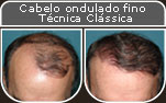 Clique para Ampliar e veja os resultados da cirurgia de implante de cabelo