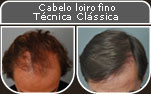 Clique para Ampliar e veja os resultados da cirurgia de implante de cabelo