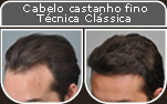 Clique para Ampliar e veja os resultados da cirurgia de implante de cabelo