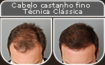 Clique para Ampliar e veja os resultados da cirurgia de implante de cabelo