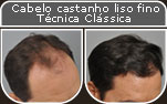Clique para Ampliar e veja os resultados da cirurgia de implante de cabelo
