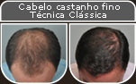Clique para Ampliar e veja os resultados da cirurgia de implante de cabelo