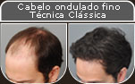 Clique para Ampliar e veja os resultados da cirurgia de implante de cabelo