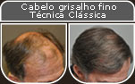 Clique para Ampliar e veja os resultados da cirurgia de implante de cabelo