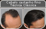 Clique para Ampliar e veja os resultados da cirurgia de implante de cabelo