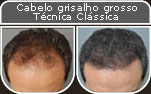 Clique para Ampliar e veja os resultados da cirurgia de implante de cabelo