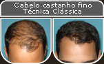 Clique para Ampliar e veja os resultados da cirurgia de implante de cabelo