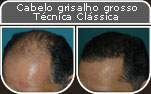 Clique para Ampliar e veja os resultados da cirurgia de implante de cabelo