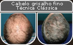 Clique para Ampliar e veja os resultados da cirurgia de implante de cabelo
