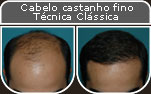 Clique para Ampliar e veja os resultados da cirurgia de implante de cabelo