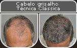 Clique para Ampliar e veja os resultados da cirurgia de implante de cabelo