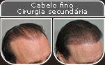 Clique para Ampliar e veja os resultados da cirurgia de implante de cabelo