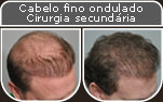 Clique para Ampliar e veja os resultados da cirurgia de implante de cabelo